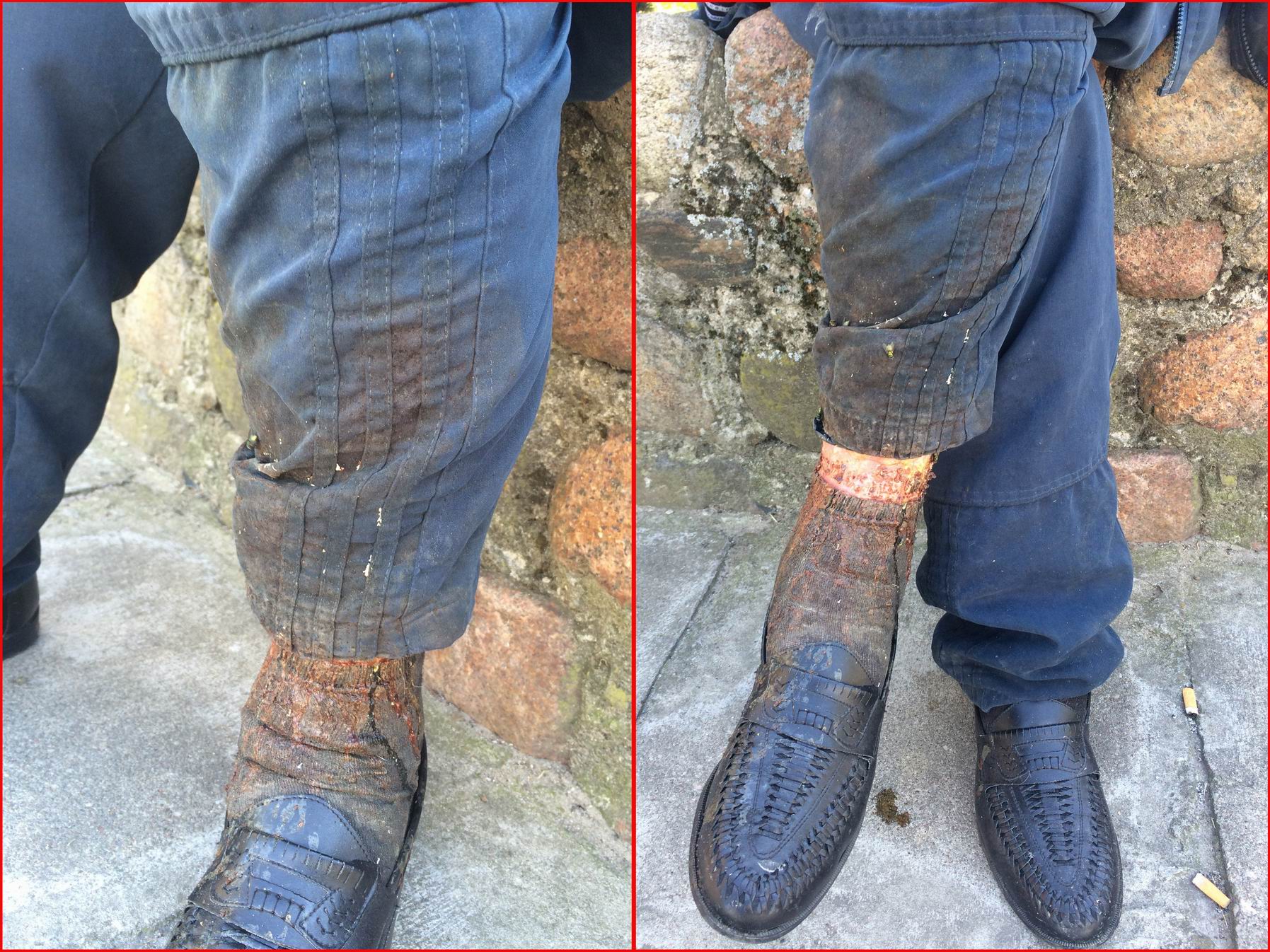 Bezdomny Noga 1 Fundacja Ja Jestem