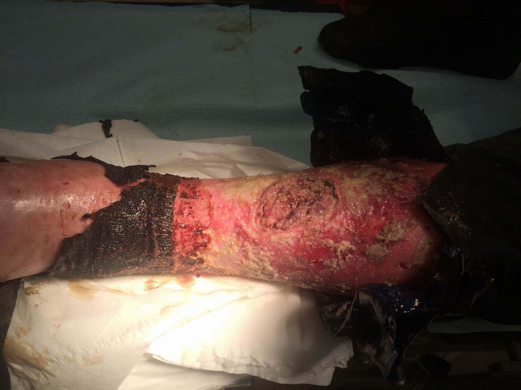 Bezdomny Noga 2 Fundacja Ja Jestem