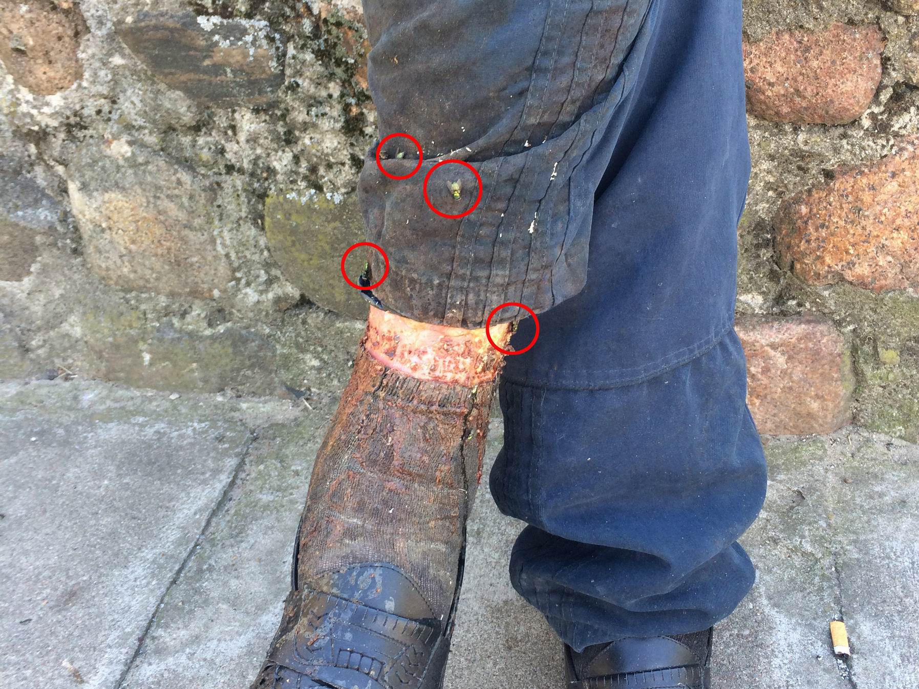 Bezdomny Noga 3 Fundacja Ja Jestem